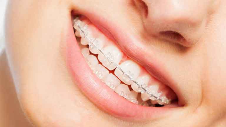 Braces