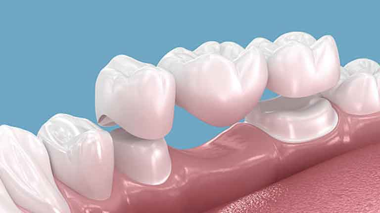 Dental Bridges