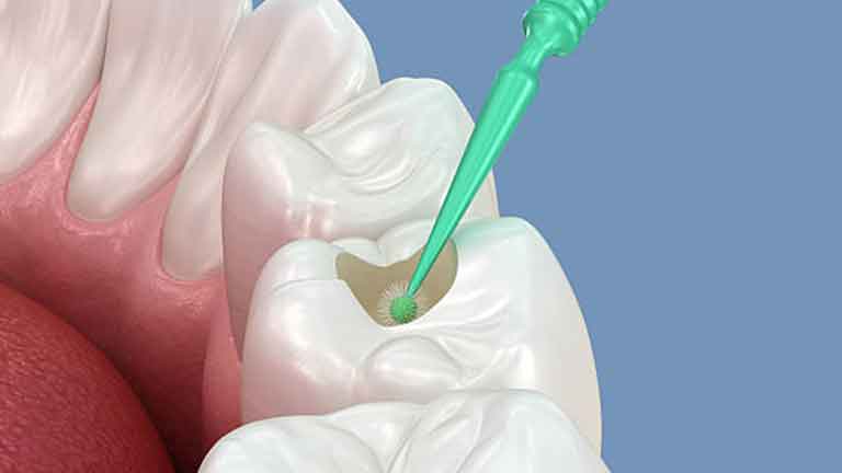 Dental Fillings