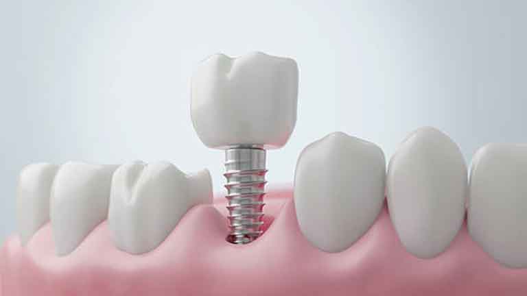 Implant Crowns