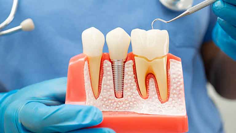 Dental Implants