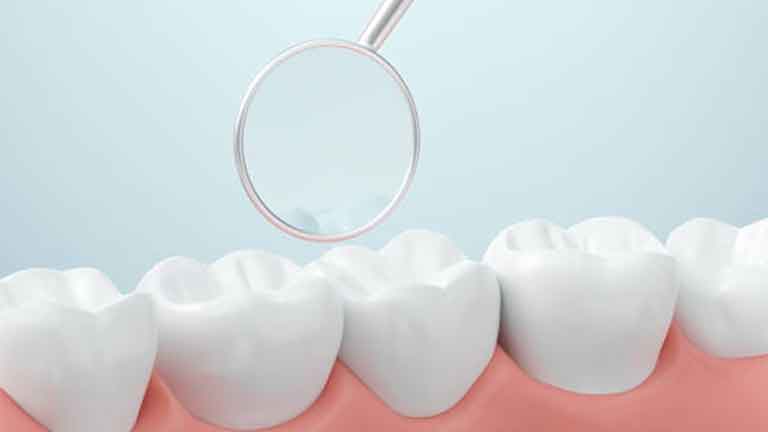 Periodontal Maintenance