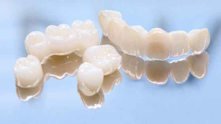 Porcelain Crowns