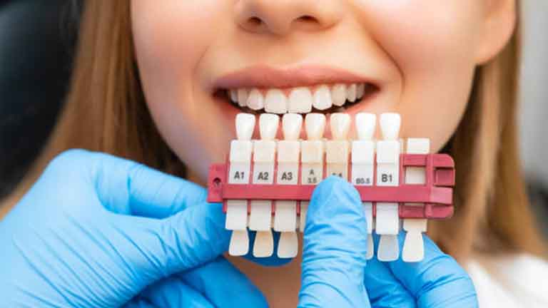 Porcelain Veneers
