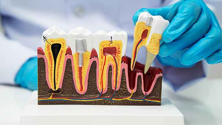 Root Canal Therapy