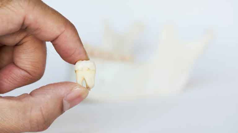 Wisdom Teeth Removal